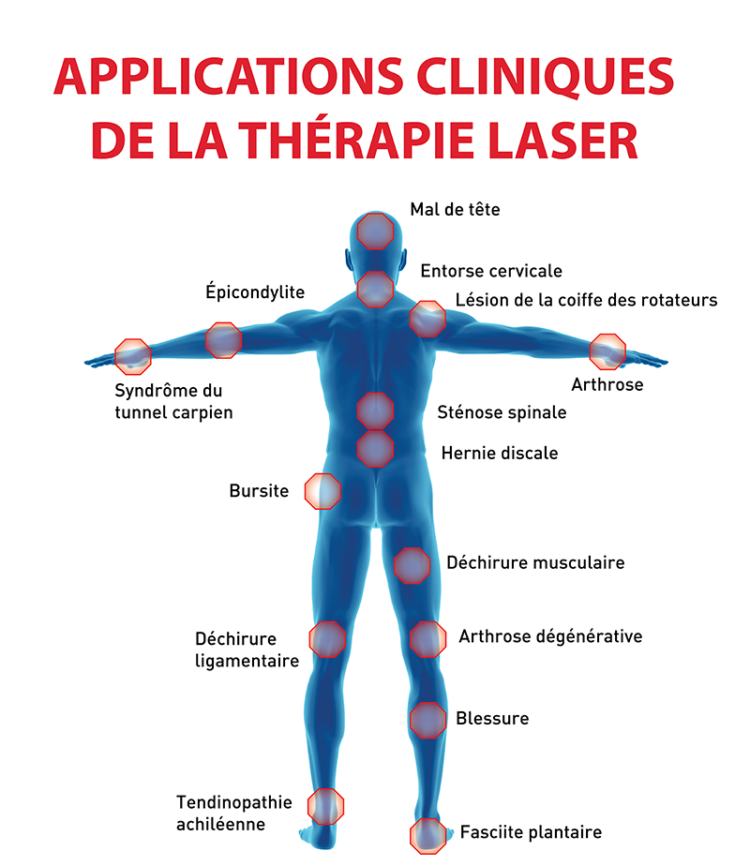 La thérapie par le laser